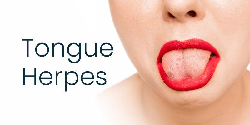 Tongue Herpes: Symptoms, Diagnosis, and Treatment